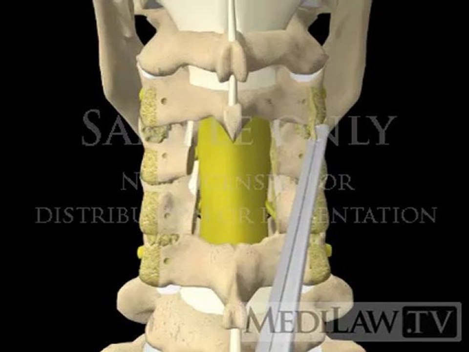 Cervical Spine Surgery Decompression Laminectomy + Lateral Mass Screw Fusion Fixation neurosurgical videos
