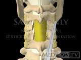 Cervical Spine Surgery Decompression Laminectomy + Lateral Mass Screw Fusion Fixation neurosurgical videos