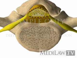 Lumbar Spine Pathology Congenital Stenosis malpractice videos