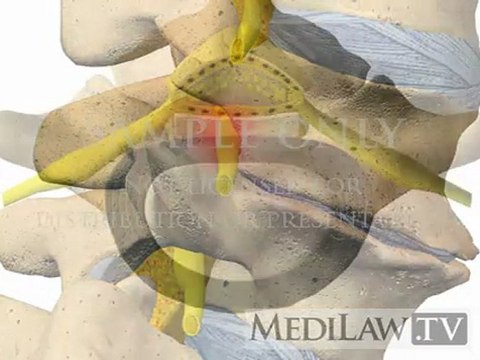 Lumbar Spine Pathology Degenerative Disc Disease informed consent videos