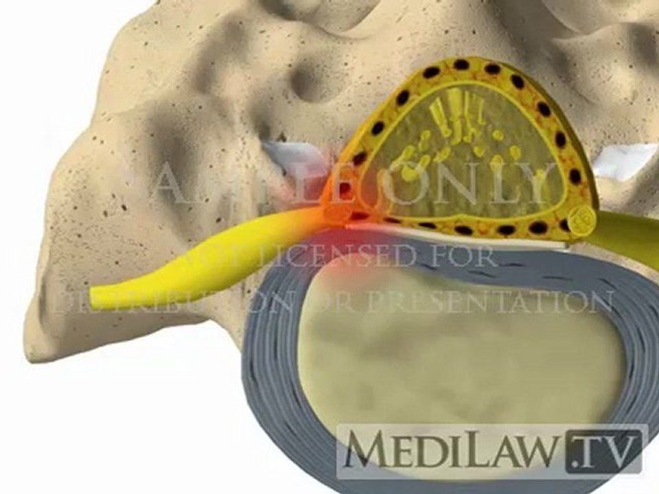 Lumbar Spine Pathology Intervertebral Disc Protrusion neuro-surgeon videos