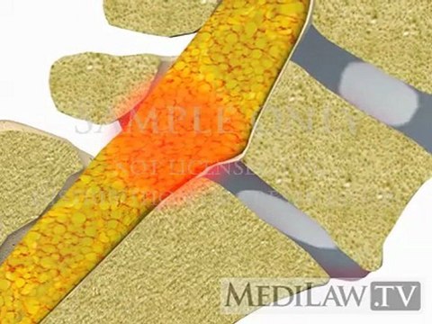 Lumbar Spine Pathology Spondylolisthesis Degenerative surgical fusion videos
