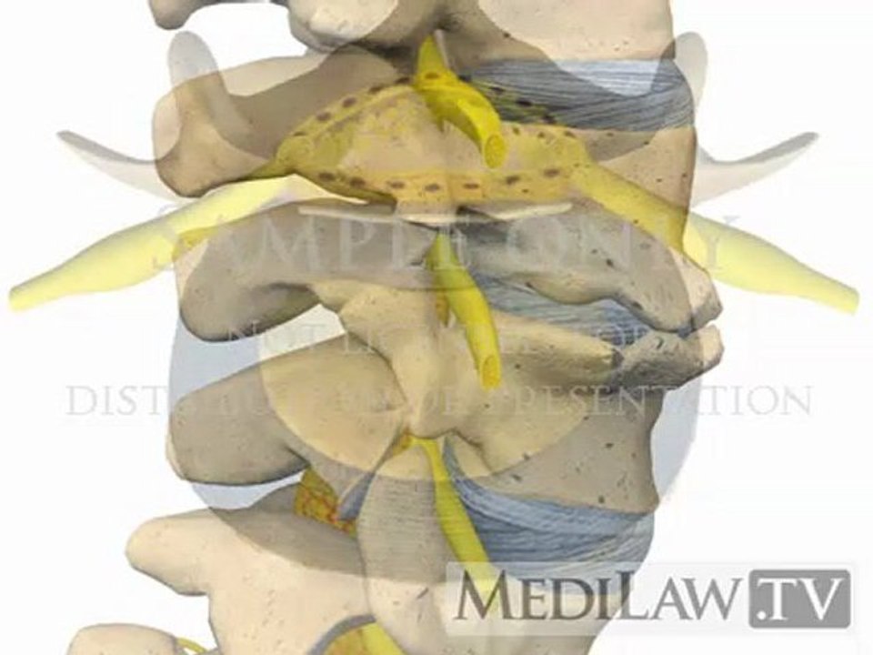 Lumbar Spine Pathology Spondylosis Deformans physiotherapy animations