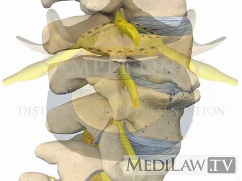 Lumbar Spine Pathology Spondylosis Deformans physiotherapy animations