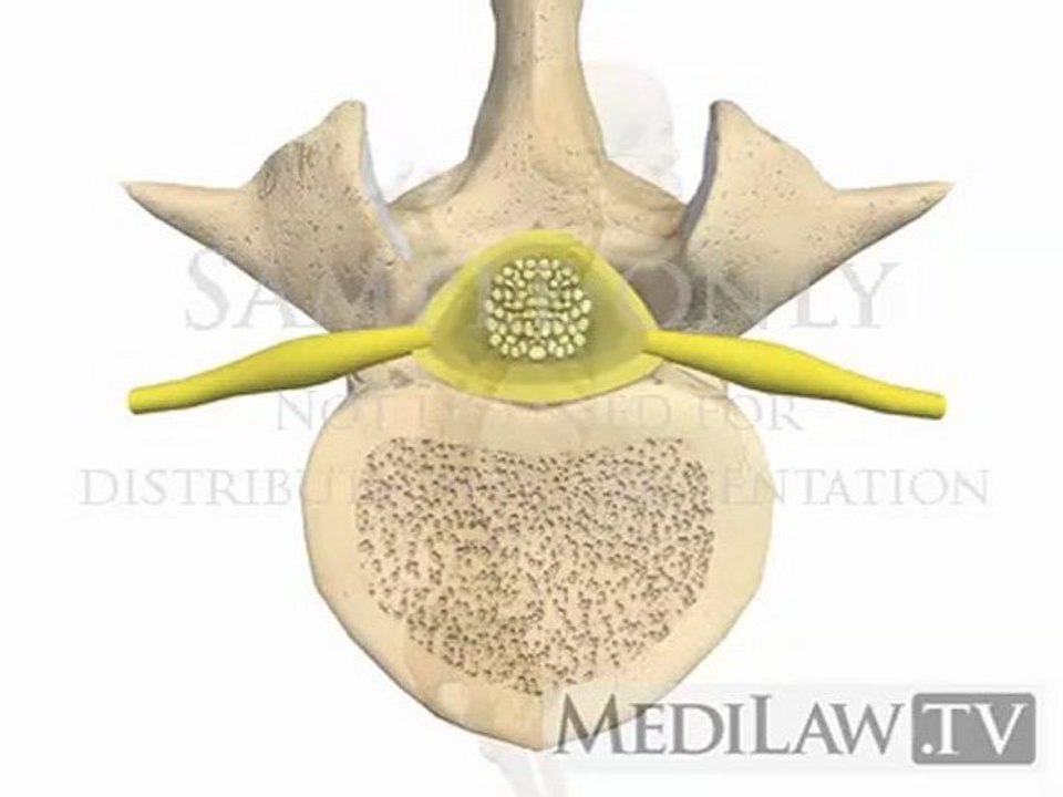 Lumbar Spine Pathology Vertebral Wedge Compression Fracture medical-legal videos