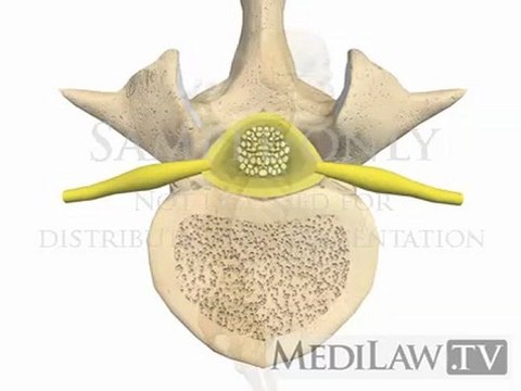 Lumbar Spine Pathology Vertebral Wedge Compression Fracture medical-legal videos