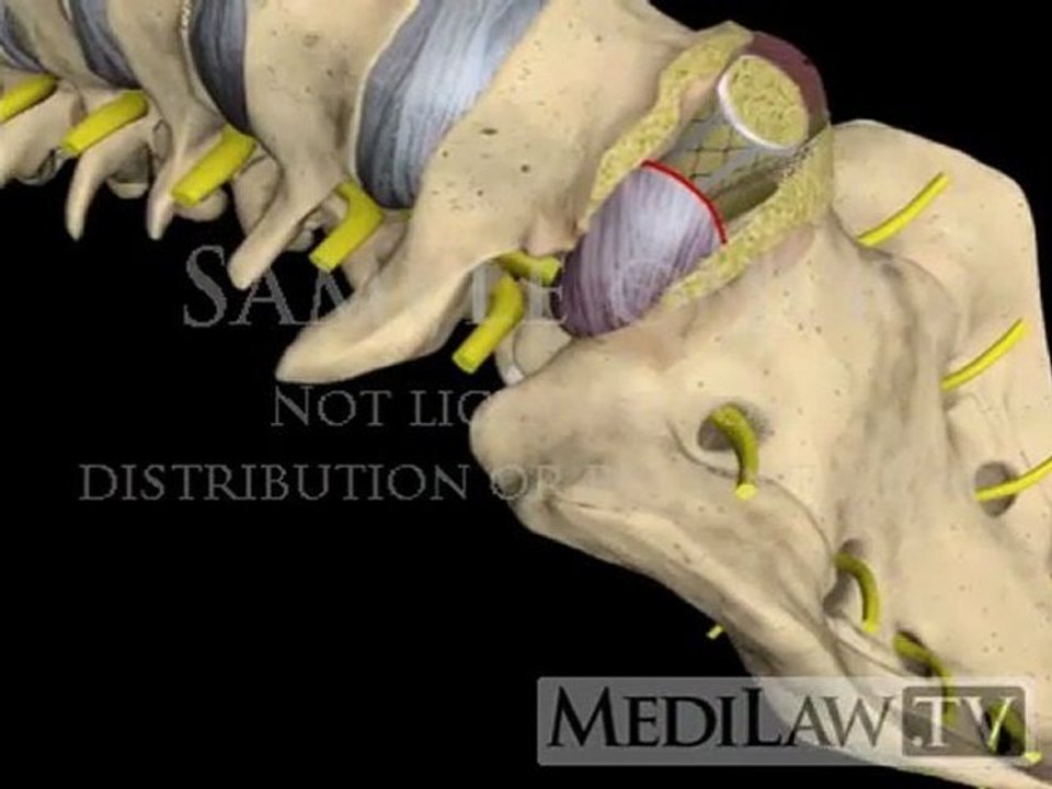 Lumbar Spine Surgery Anterior Interbody Fusion with cage neuro-surgery videos