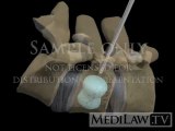 Lumbar Spine Surgery Percutaneous Balloon Vertebroplasty Kyphoplasty medical legal 3D animations