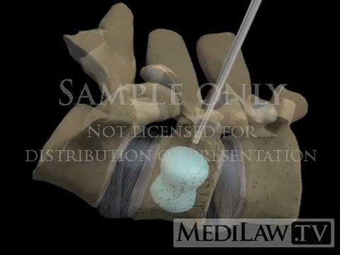 Lumbar Spine Surgery Percutaneous Balloon Vertebroplasty Kyphoplasty medical legal 3D animations