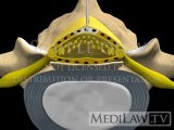 Lumbar Spine Surgery Epidural Injection interlaminar medical evidence 3D animations