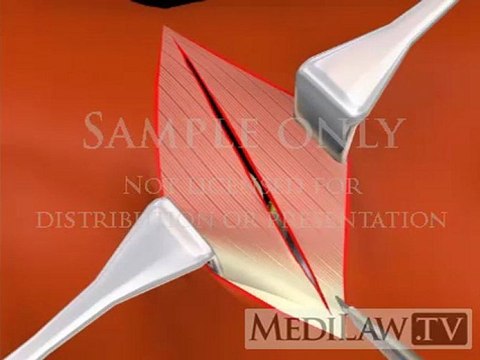 Lumbar Spine Surgery Flank Surgical Approach lawsuit 3D animations