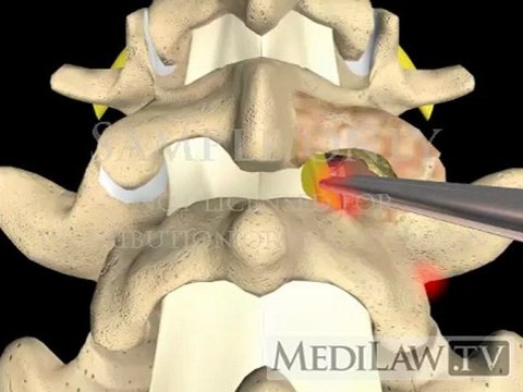 Lumbar Spine Surgery Foraminotomy extended informed consent movies