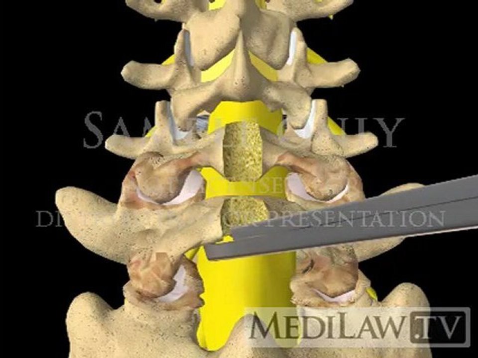 Lumbar Spine Surgery Laminectomy expert witness testimony 3D animations