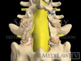 Lumbar Spine Surgery Pedicle Screw Fixation Fusion medical negligence 3D animations