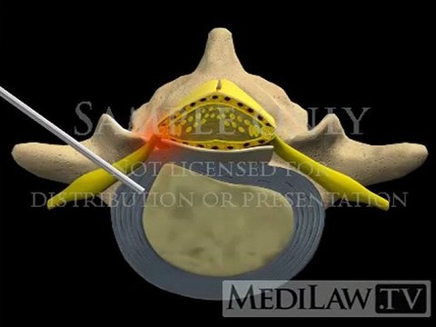 Lumbar Spine Surgery Percutaneous Automated Discectomy operation movies