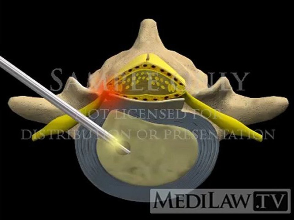 Lumbar Spine Surgery Percutaneous Endoscopic Discectomy patient education movies