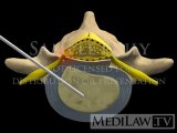Lumbar Spine Surgery Percutaneous Laser Discectomy personal injury illustrations