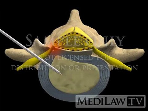 Lumbar Spine Surgery Percutaneous Thermal Discectomy spine education movies