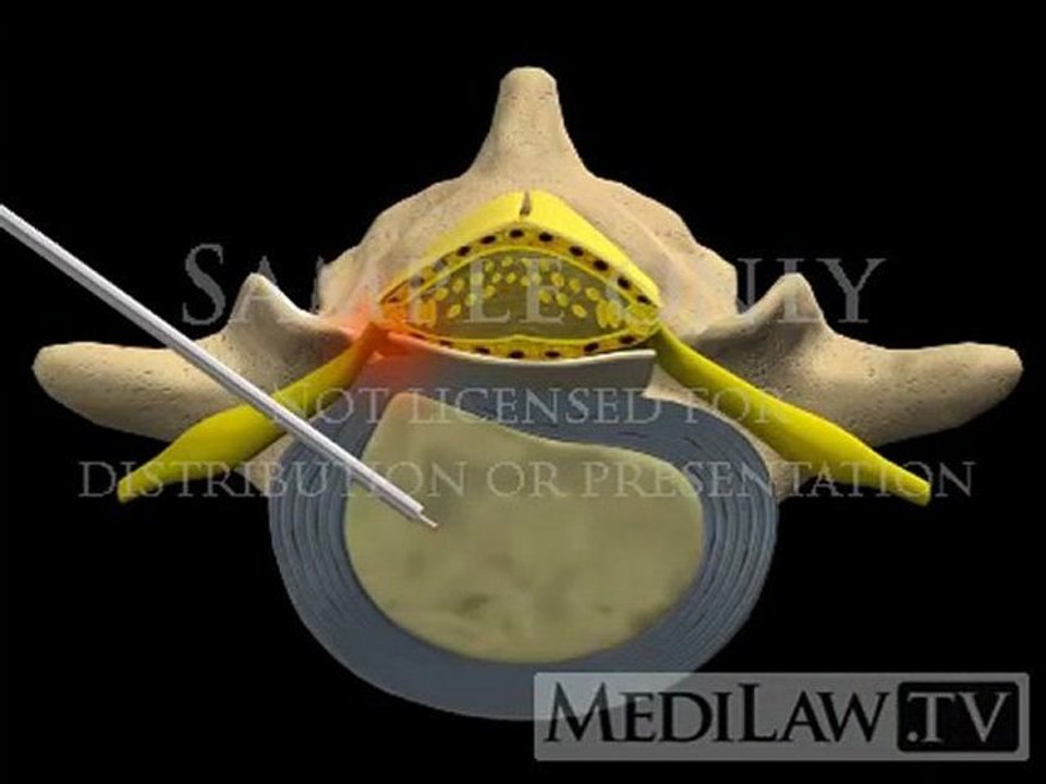 Lumbar Spine Surgery Percutaneous Thermal Discectomy spine education movies