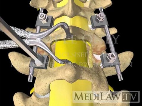 Lumbar Spine Surgery Posterior Interbody Vertebral Fusion with cage orthopaedic surgery videos