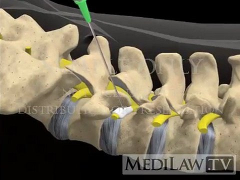 Lumbar Spine Surgery Selective Nerve Root Block Injection neurosurgery movies