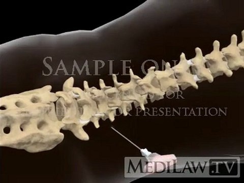 Lumbar Spine Surgery Vertebral Body Biopsy nursing 3D animations