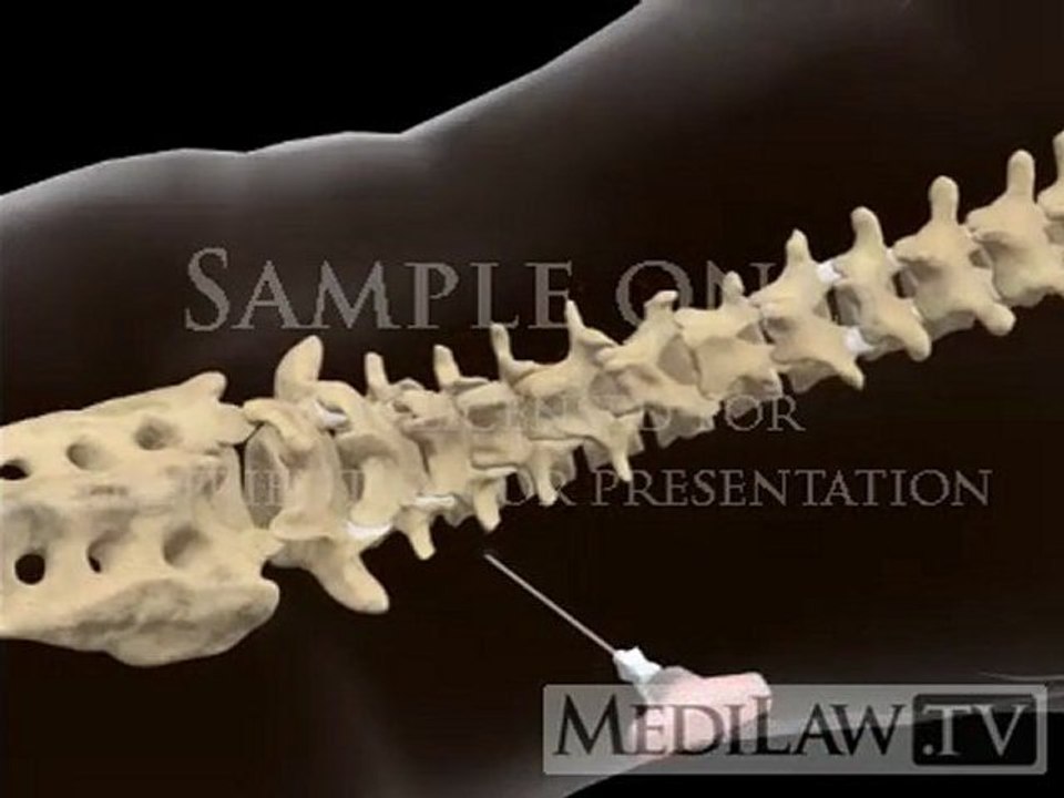 Lumbar Spine Surgery Vertebral Body Biopsy nursing 3D animations