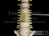 Lumbar Spine Surgery Vertebrectomy Corpectomy with cage   plate medicolegal exhibit 3D animations