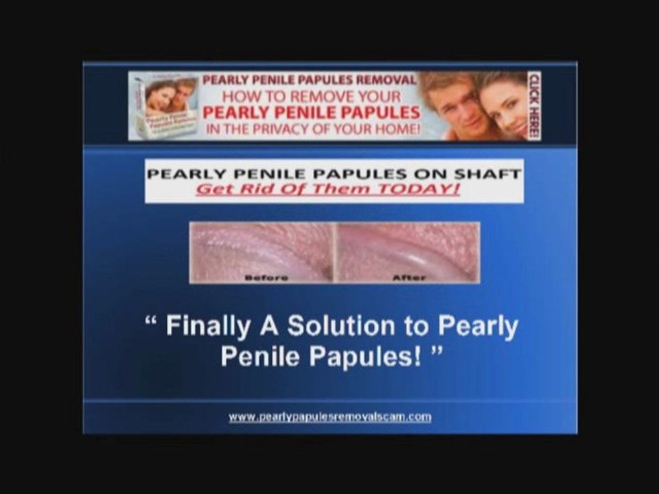 Fordyce spots - Penile Papules Removal