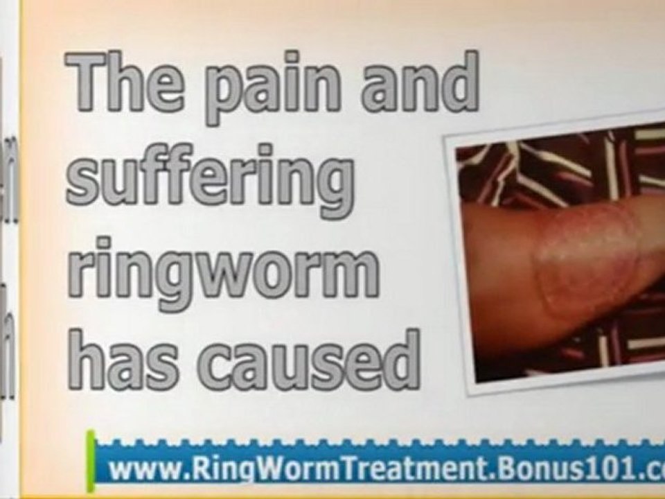how to get rid of ringworm fast - treatments for ringworm - ringworm natural treatment