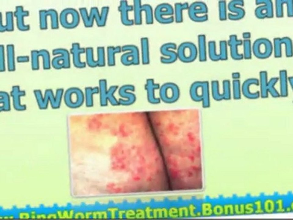 how to treat ringworm - treatment for ringworm - treating ringworm