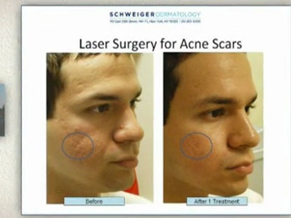 Get rid of Acne through Acne Laser Skin Treatment from Schweiger Dermatology