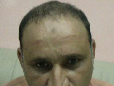 Hair Transplant Cost | Hair Loss Surgery Price | Hair Transplantation Fee | in Pakistan