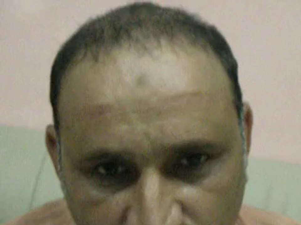 Hair Transplant Cost | Hair Loss Surgery Price | Hair Transplantation Fee | in Pakistan