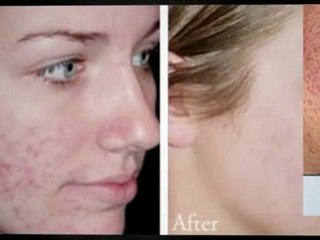 Tips For Getting Rid Of Pimples