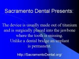 Sacramento Dental What is a Dental Implant