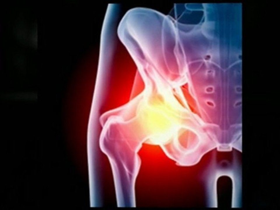 DePuy Hip Recall - Seeking Assistance