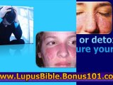 skin lupus - skin lupus treatment