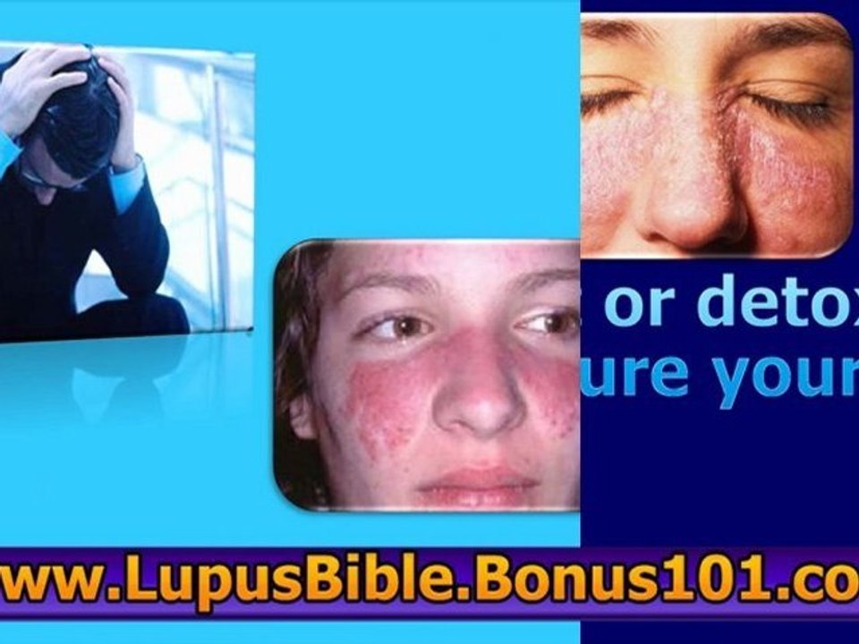 skin lupus - skin lupus treatment