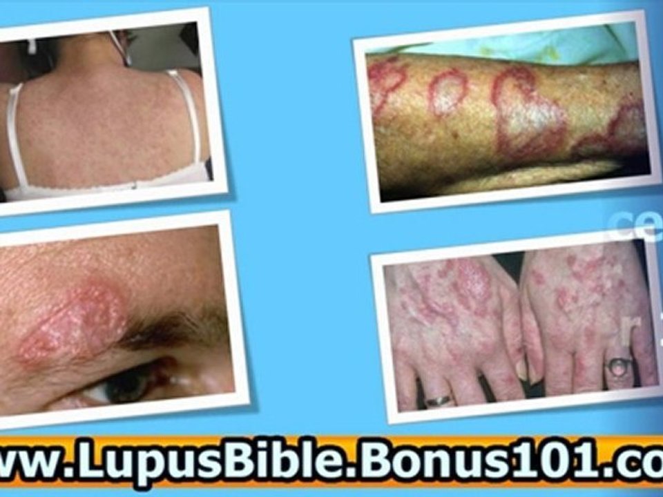 lupus skin diaease - lupus sleep problems - lupus symptoms