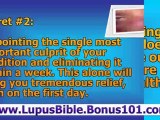 lupus rashes - lupus relief - lupus nephritis