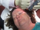 Facial Skin Resurfacing With Erbium Laser-Eye Bag Laser Treatment-Facial Skin Tightening