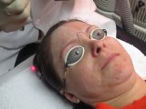 Facial Skin Resurfacing-Erbium Laser Peel-Fotona Dualis XS European Laser-Valley Aesthetics and Laser