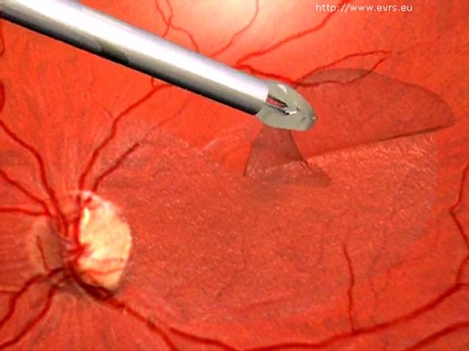 Makulaödem &   makulamembranen