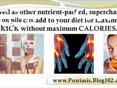 natural psoriasis remedies - psoriasis herbal treatment