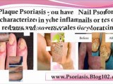 home remedies for psoriasis - natural remedies for psoriasis