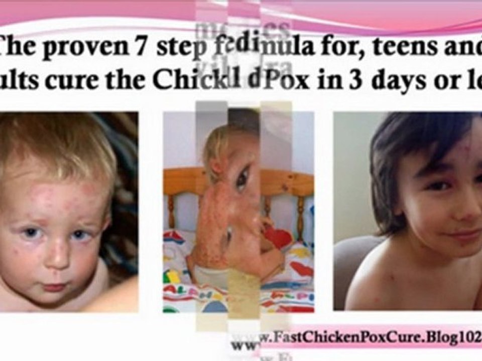 calamine lotion chicken pox early stages of chicken pox how to get