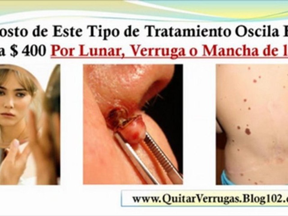 manchas blancas en la piel por el sol - como quitar lunares de la cara