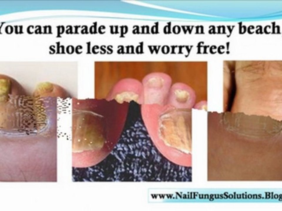 treatment for nail fungus - nail fungus treatments - nail fungus remedy