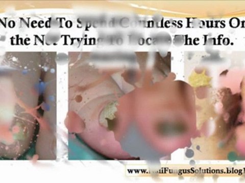 home remedies for nail fungus - natural nail fungus treatment - nail fungus treatments